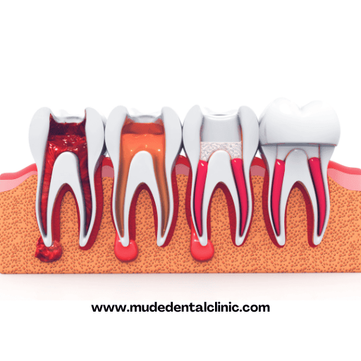What is Root Canal?